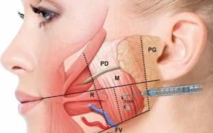 Botox injection into the masseter muscle for sleep bruxism and TMJ pain relief