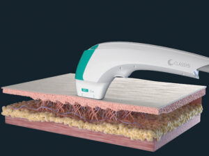 Ultraformer MPT Mode